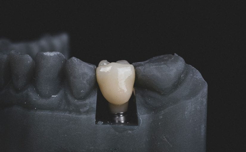 Beyond the Smile: The Ripple Effect of Dental Implants on Overall Health