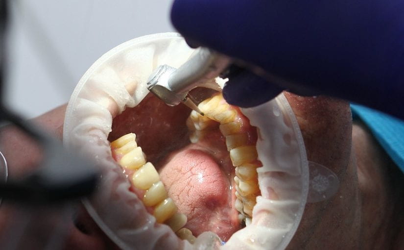 What Is Dental Plaque and How Can I Get Rid of It?